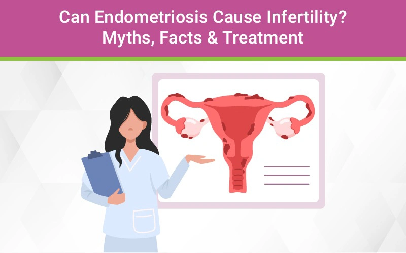 Can Endometriosis Cause Infertility? Myths, Facts & Treatment