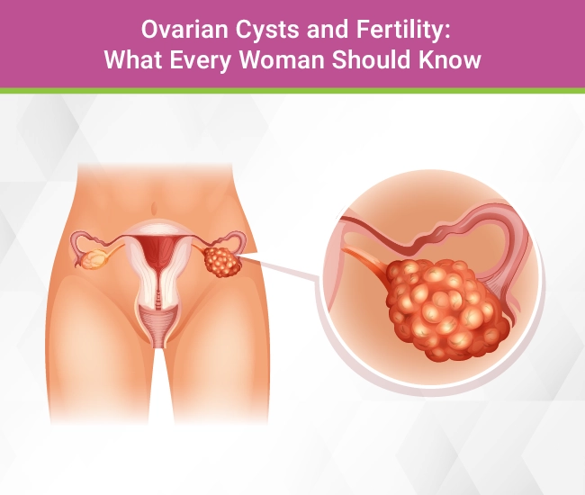 Ovarian Cysts and Fertility: What Every Woman Should Know